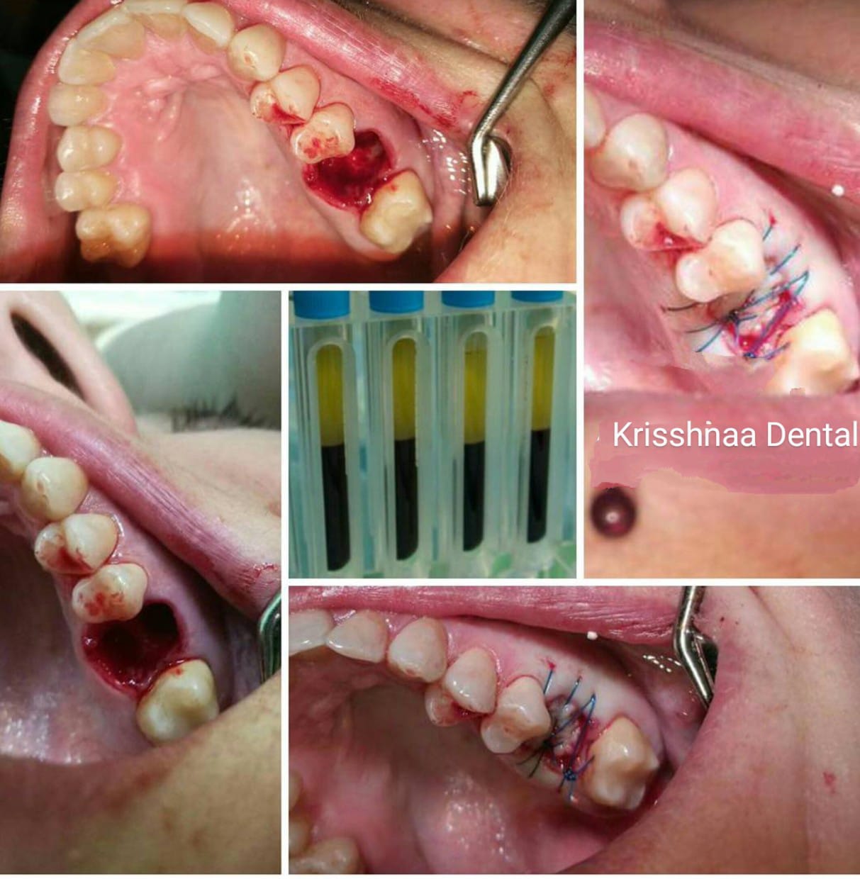 How PRF Therapy Can Enhance Healing After Tooth Extractions